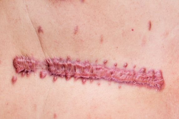 When Is the Right Time to Start Hypertrophic Scar Treatment?