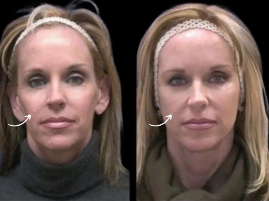 Who Is the Ideal Candidate for Sculptra Treatments in Dubai