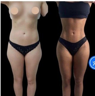 Restore Your Confidence with J-Plasma Skin Tightening in Dubai