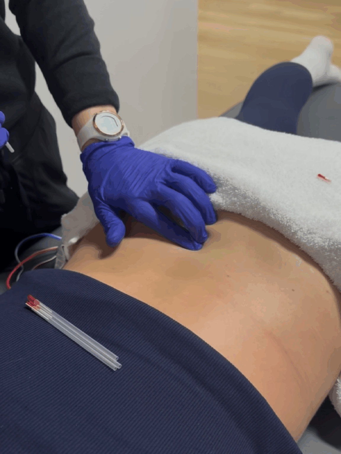 Dry Needling: A Complete Guide to Pain Relief and Recovery at Flexology Studios
