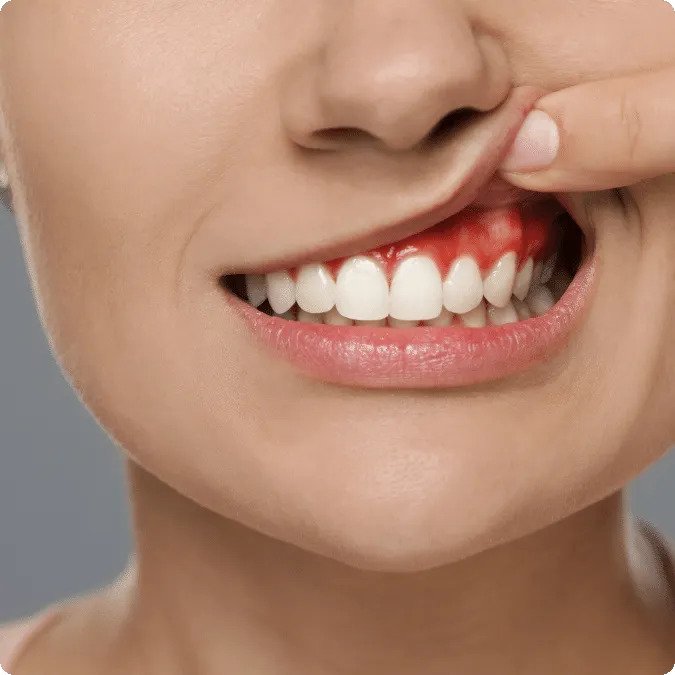 Prevent Tooth Loss with Advanced Gum Treatment in Dubai