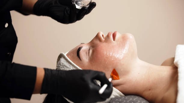 Chemical Peels That Support Smooth Radiance
