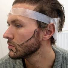 Can Beard Hair Transplant in Islamabad Enhance Facial Appearance?