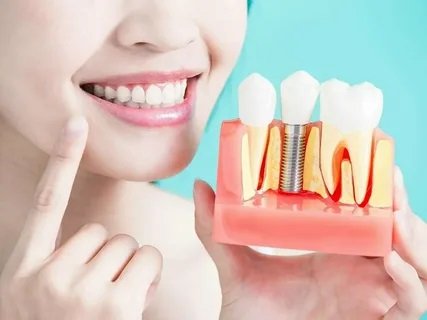 Can Dental Implants in Islamabad Fail?