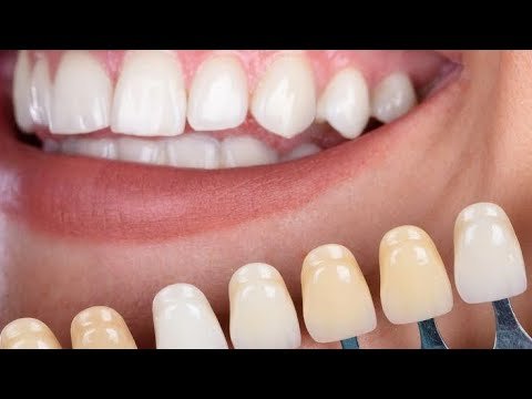 What Is the Difference Between Porcelain and Ceramic Crowns in Islamabad?