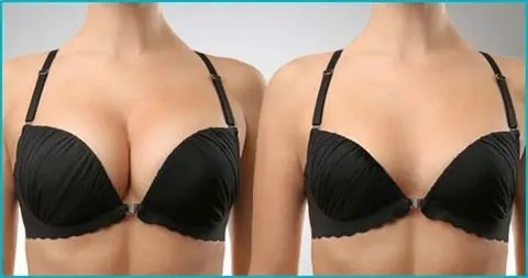 Are There Any Hidden Costs in Breast Augmentation in Islamabad Packages?