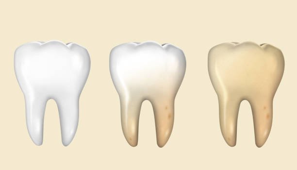 Top Causes of Tooth Discoloration and How Whitening Helps