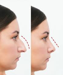 Discover Your Best Self: Transformative Rhinoplasty in Riyadh
