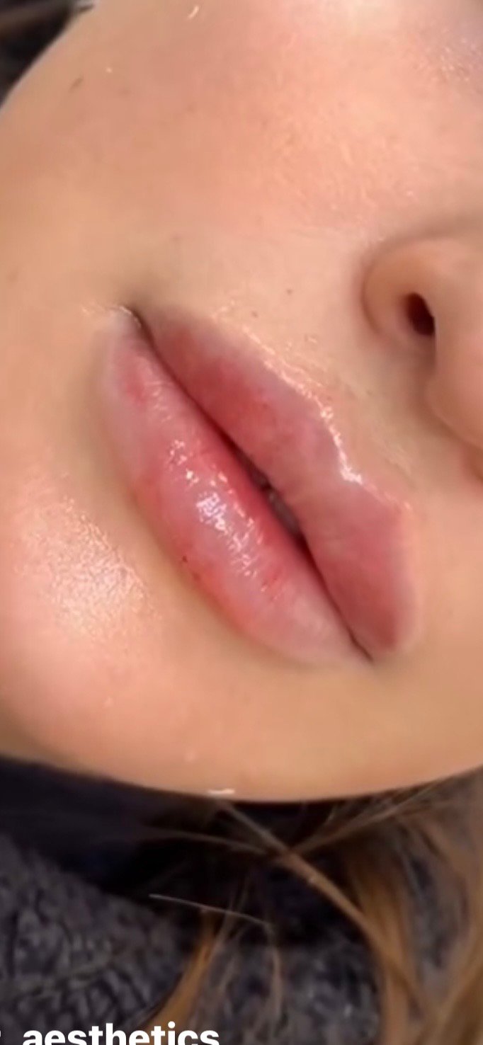 Russian Lips - Lippen aufspritzen Schweiz: Wissenswertes