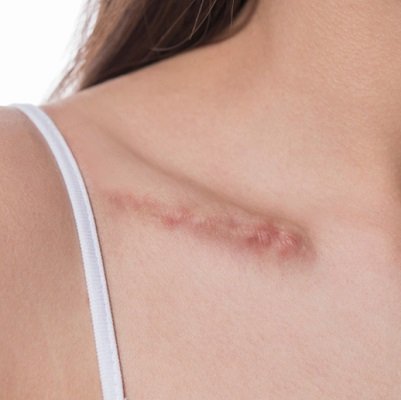 Is Hypertrophic Scar Treatment Safe for All Skin Types?