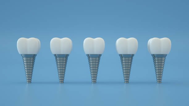 Top 5 Reasons to Choose Dental Implants for Missing Teeth