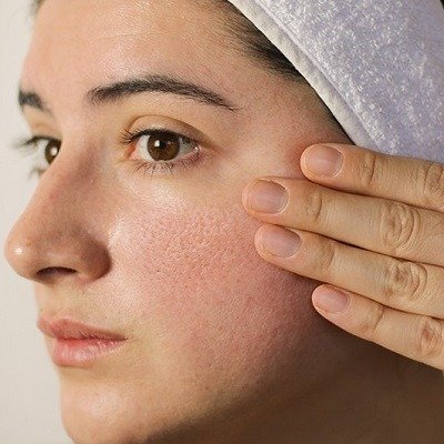 What Are the Most Effective Solutions for Large Open Pores?