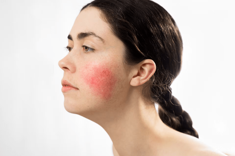 Can Rosacea Affect Men and Women Differently?